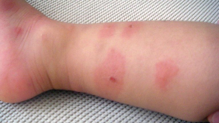 аллергия на укус клопа у человека фото