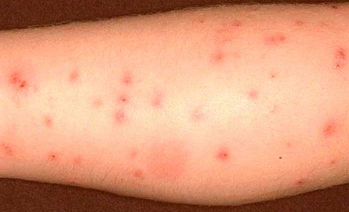 Симптомы того, что вами покормились (зуд, покраснения и отек), становятся видны только через несколько часов после укуса. фото укусов клопов